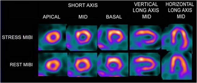 Cardiolite scan